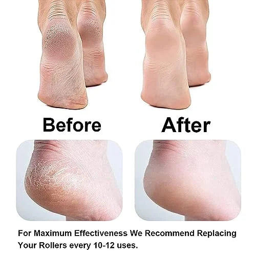 Electric Callus Remover